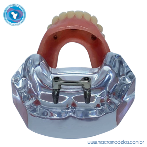 Macro Modelo Overdenture Mand Bula Acr Lica Barra Clip Pr Tese