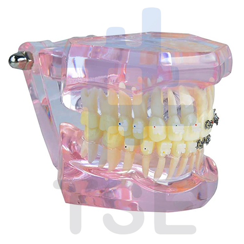 Modelo De Ortodoncia Con Brackets Ceramicos TSE