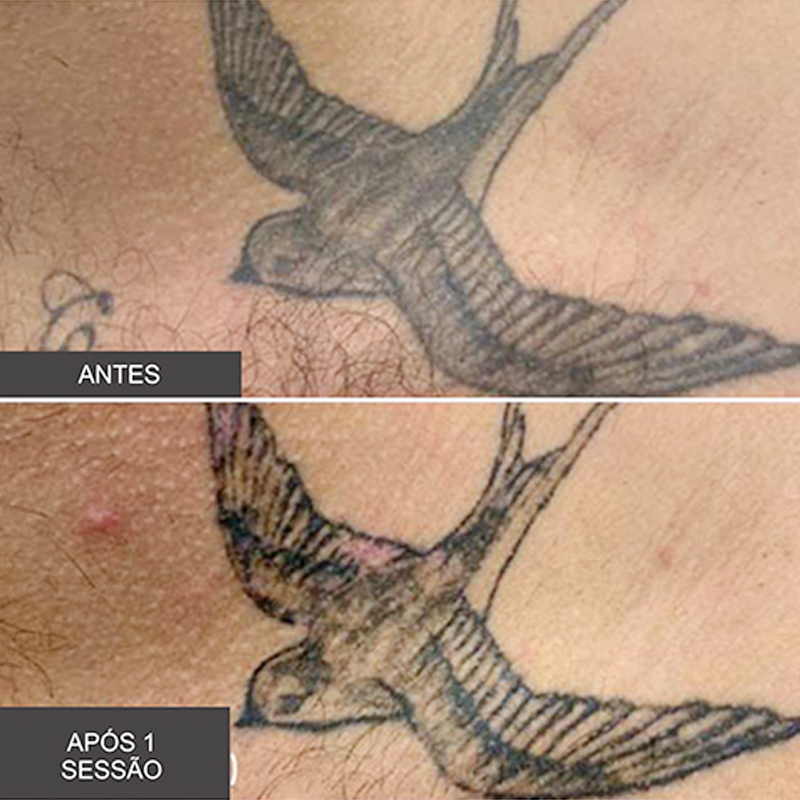 Apagar tatuagem a laser em fortaleza Tratamento A Laser Para Remocao De Tatuagens Em Fortaleza Estetica Corpo O Laser Revlite Q Switched Nd Yag Remove Com Efetividade Tatuagens Das Mais Diversas Cores As Azuis E Pretas Sao As Mais