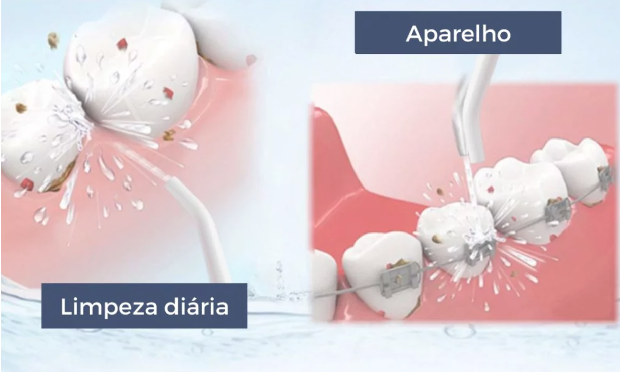 Como funciona o irrigador dental