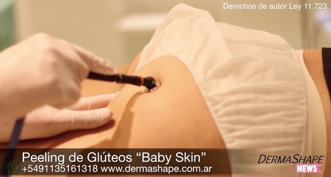 Carrusel limpieza de cutis con puntos negros y tratamientos  a domicilio en buenos aires