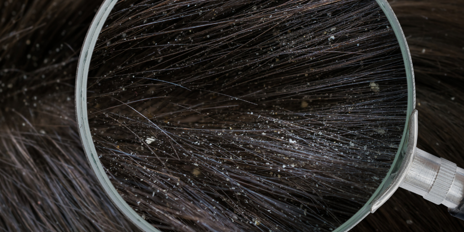 Quais os melhores shampoos em barra para caspa?