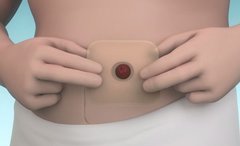 COLOPLAST - Accesorios para Ostomía - comprar online