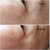 RF Trimax II, radiofrecuencia tripolar, multipolar y fraccionada. - comprar online